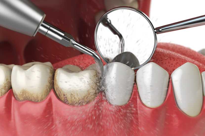 Periodontal-therapy
